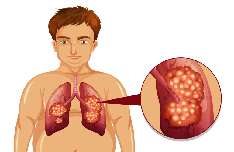  Interstitial Lung Disease