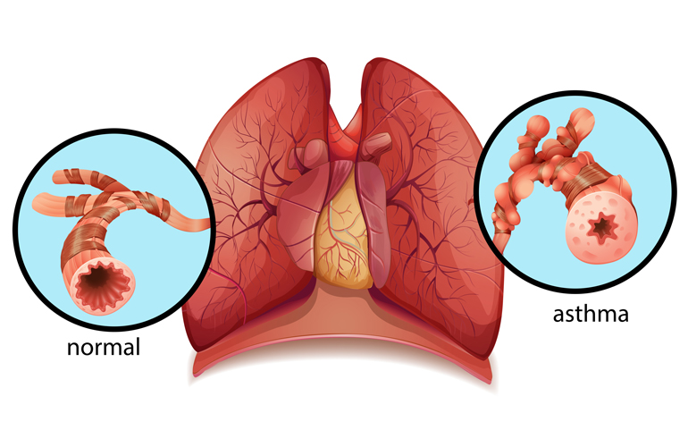 Asthma & Allergic Lung Disorders