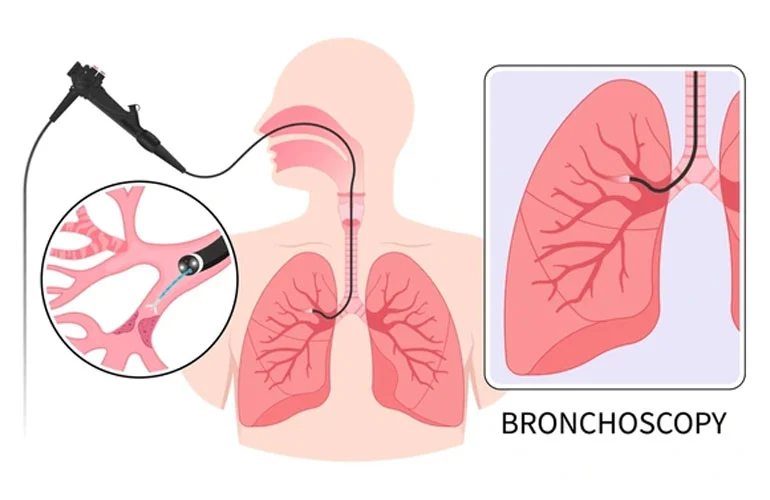 Bronchoscopy