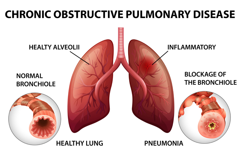 Chronic Obstructive Lung Disease (COPD)