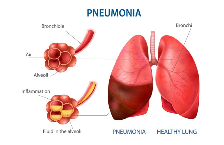  Pneumonia