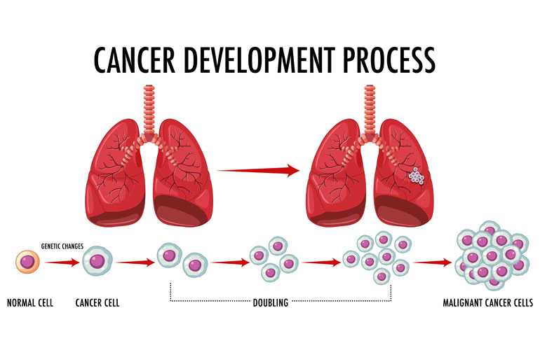 Lung Cancer