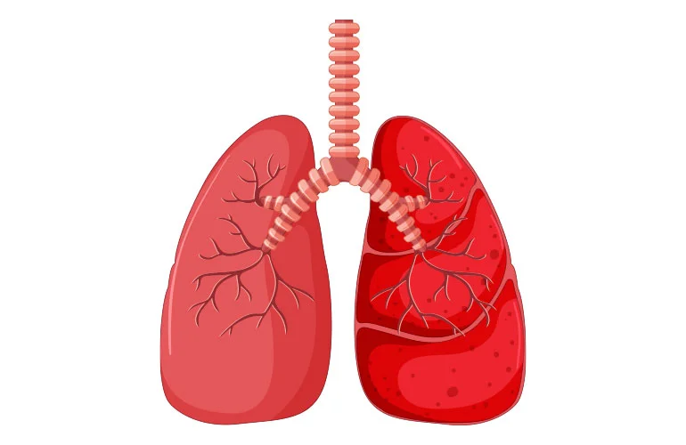  Pulmonary Haemorrhage