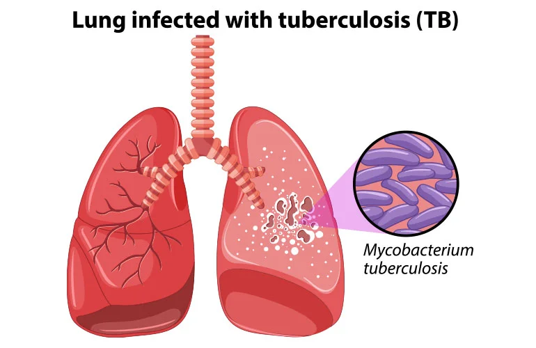 Tuberculosis