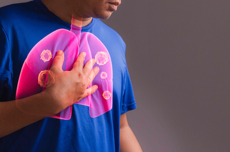 Pulmonary Haemorrhage is a serious condition where bleeding occurs within the lungs, leading to symptoms like coughing blood, breathlessness, chest discomfort, and sudden weakness. At Vizag Healthcare, Maharani Peta, Visakhapatnam, we provide urgent evaluation and expert medical care for patients showing these warning signs. Immediate diagnosis is crucial to control bleeding and prevent life-threatening complications. Our specialists conduct a detailed assessment using tests such as chest X-rays, CT scans, blood investigations, and bronchoscopy to identify the source and cause of bleeding. Pulmonary haemorrhage can occur due to infections, autoimmune diseases, lung injuries, blood disorders, or severe inflammation. Understanding the root cause allows us to provide accurate and timely treatment tailored to each patient’s condition. Treatment may include medications to control bleeding, manage underlying infections, stabilize lung function, and support breathing. In critical cases, oxygen therapy, intensive monitoring, or advanced interventions may be required. At Vizag Healthcare, we ensure that patients receive safe, evidence-based management in a controlled and compassionate environment to restore stability as quickly as possible. After the acute phase is controlled, long-term care becomes essential to prevent recurrence. Our team offers continuous follow-up, lifestyle guidance, and monitoring to ensure healthy lung recovery. For anyone experiencing unexplained coughing of blood or sudden breathing difficulty, Vizag Healthcare in Maharani Peta, Visakhapatnam, provides prompt and specialized care to protect your lung health and overall well-being.