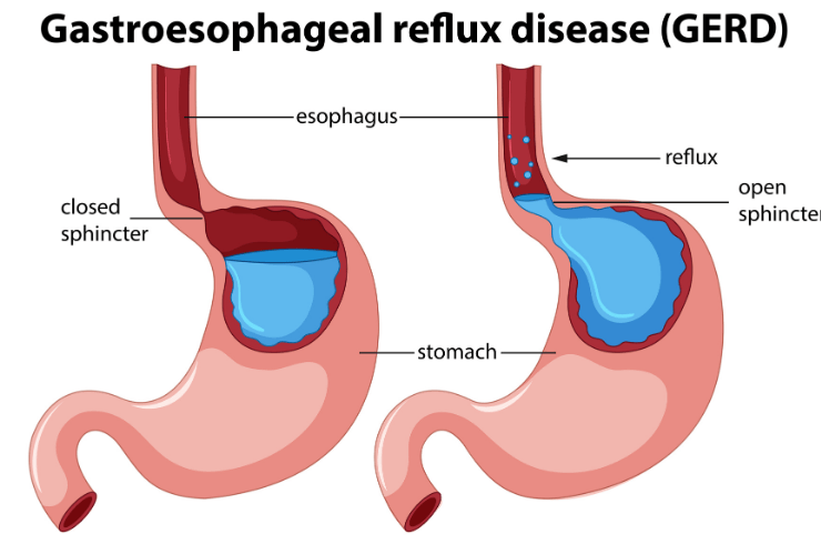 gerd
