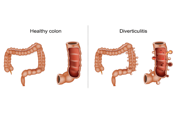 https://www.freepik.com/free-photo/displeased-young-man-with-painful-feelings-holding-belly_7785381.htm#fromView=search&page=1&position=29&uuid=8bdcaff9-ea79-4426-a2d4-3d0c5c783779&query=constipation+ constipation Diverticular disease AdobeStock_873357303.jpeg
